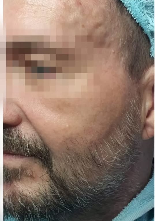 Before Collagen